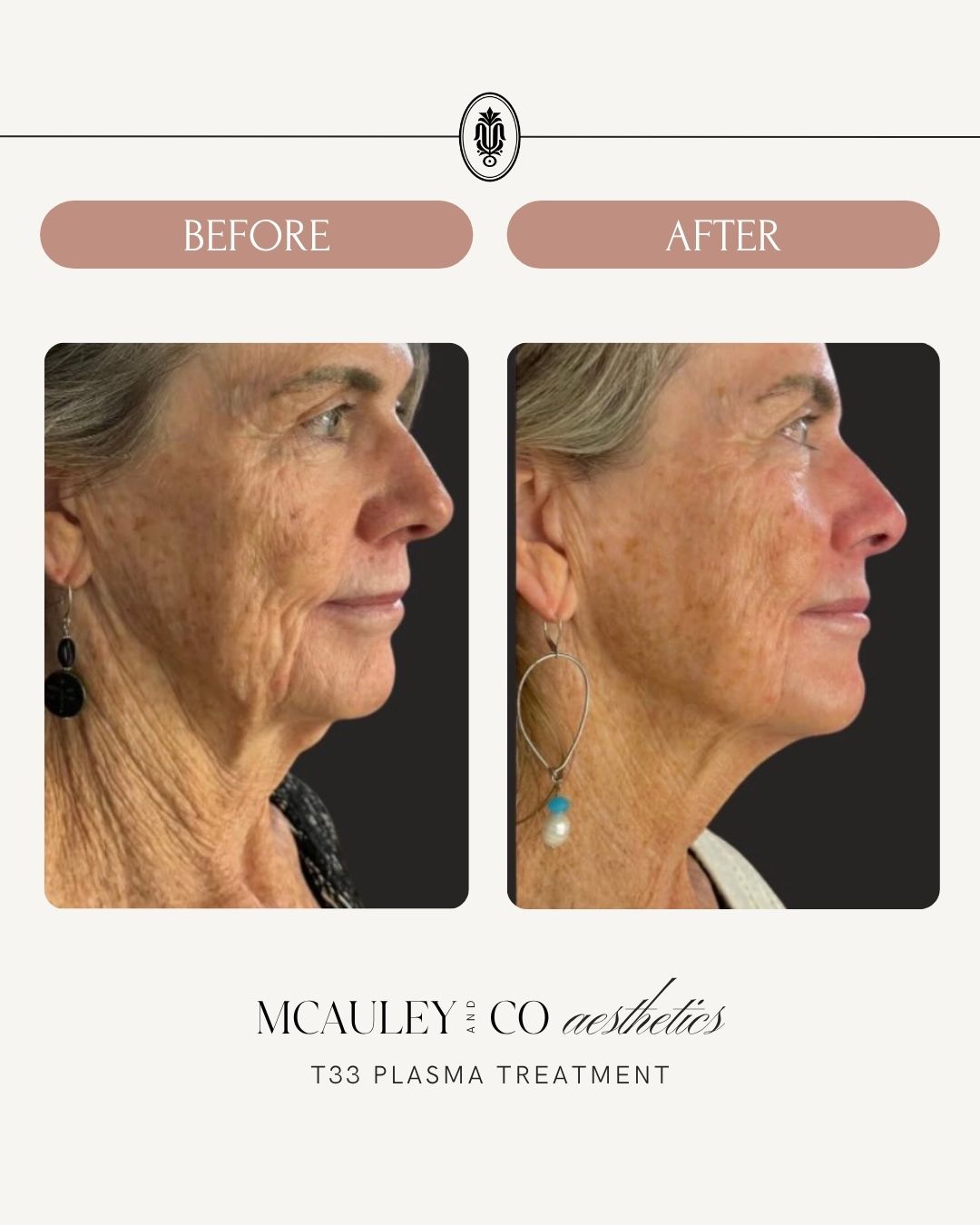 (2) T33 Regenerative Plasma Treatments