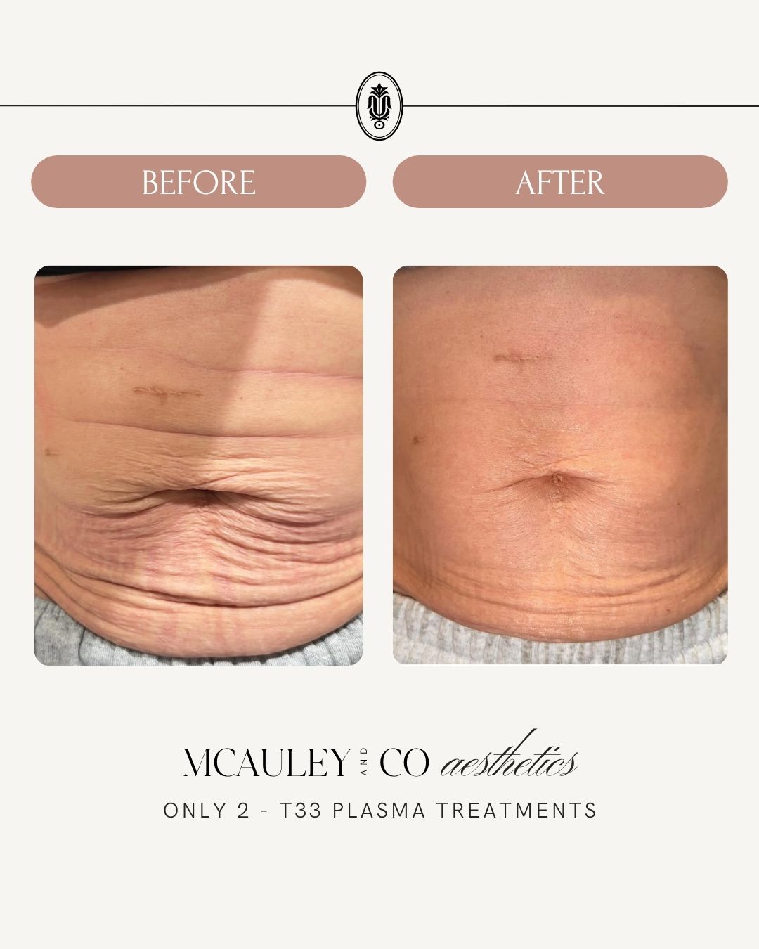 T33 Skin Tightening Transformation Series