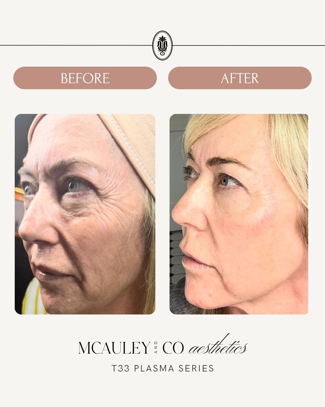 T33 Regenerative Plasma Series of 3 + 1 Complimentary