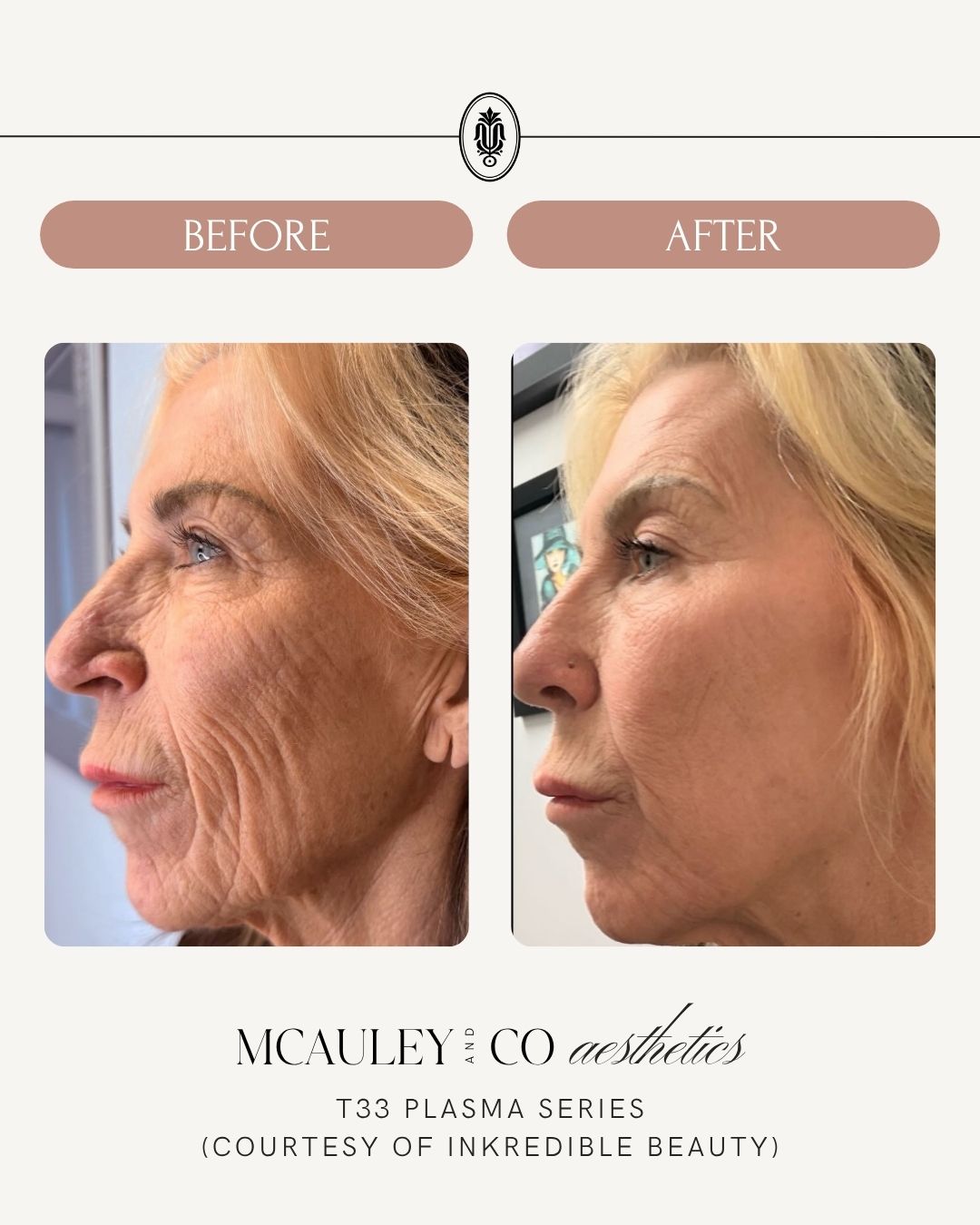 (2) T33 Regenerative Plasma Treatments