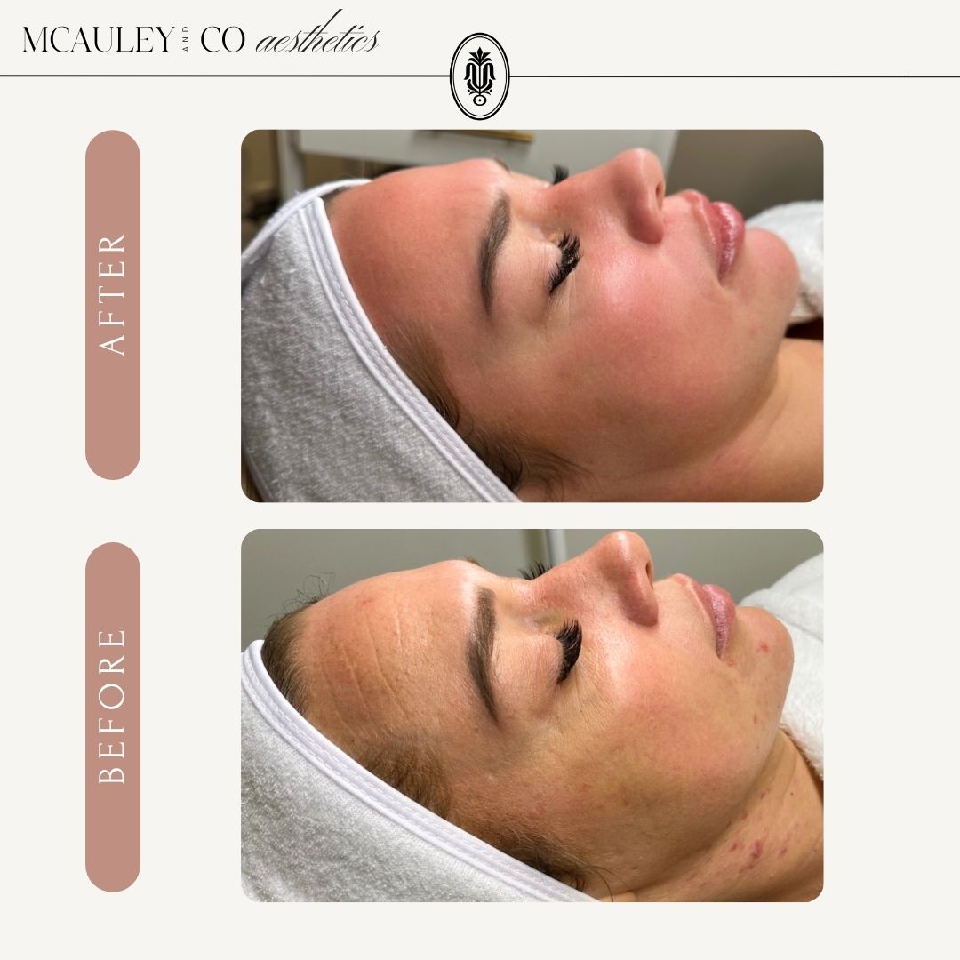 T33 Regenerative Plasma Series of 6 + 2 Complimentary